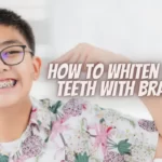 How To Whiten Your Teeth With Braces